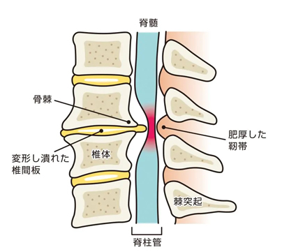 椎間板ヘルニアが起こる仕組みの図解