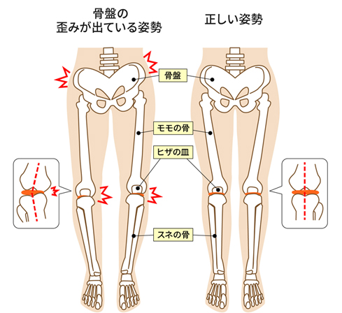 骨盤の歪みが出ている姿勢と正しい姿勢の比較図