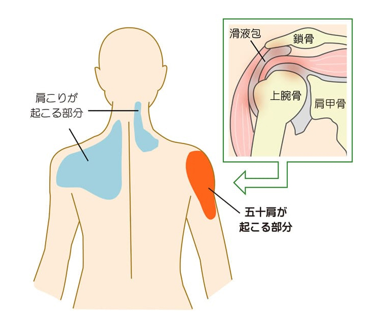 肩こりと肩まわりの不調の図解