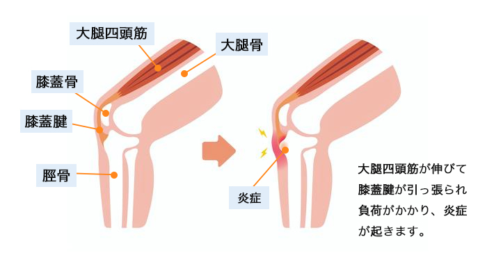 大腿四頭筋が伸びて膝蓋腱が引っ張られ、負荷がかかることで炎症が起きるメカニズム図