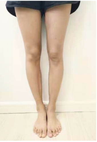 O脚の脚の写真