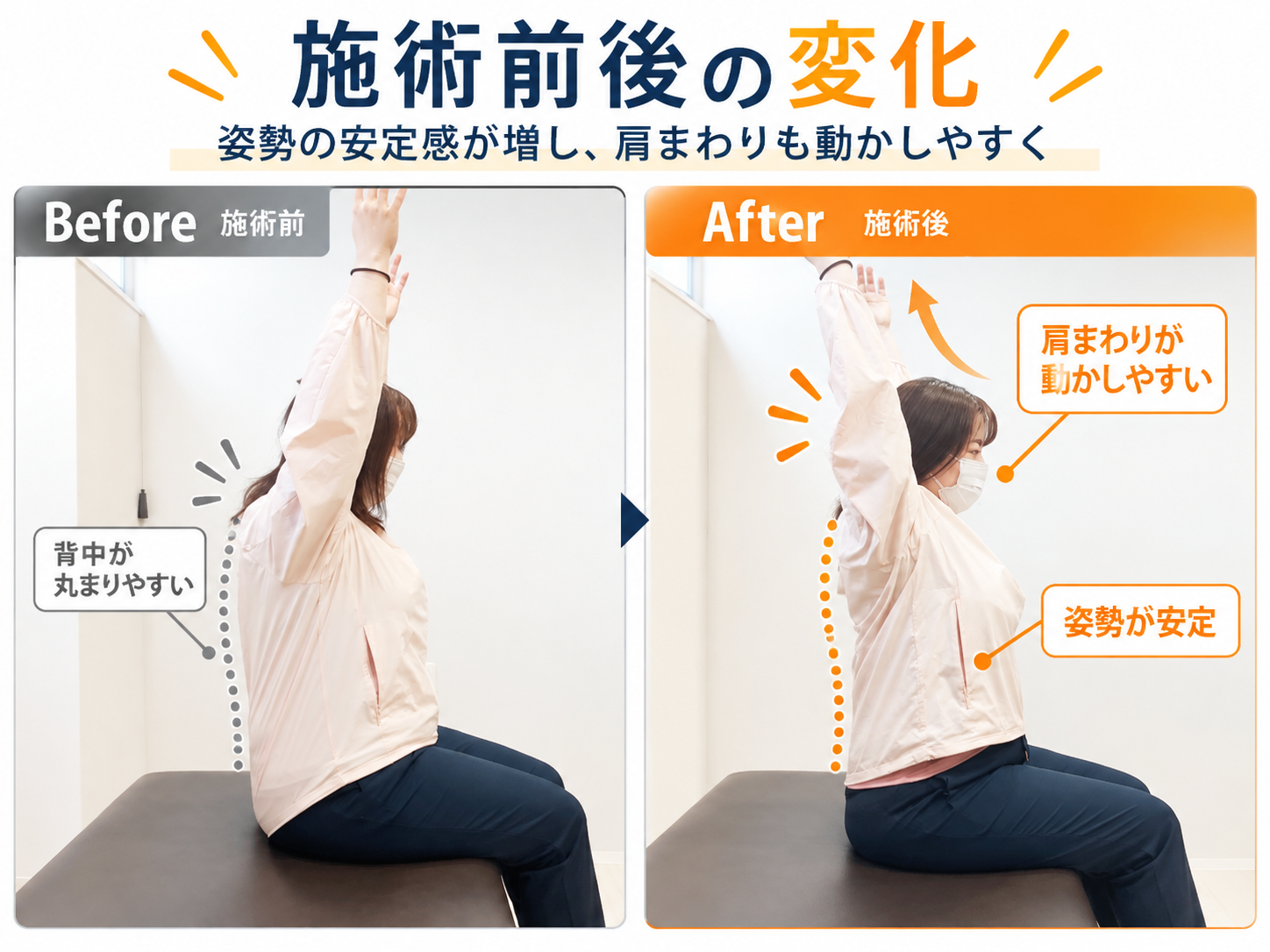 姿勢矯正のビフォーアフター比較