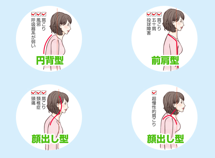 猫背の種類
